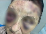 ŠOKANTNA ispovijest žene žrtve nasilja za ‘Avaz’: Suprug me pretukao dok je bio pijan, pobjegla sam bosa da ne budem ubijena